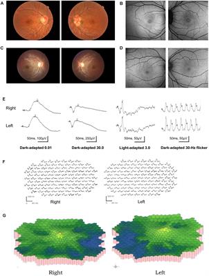 Next-Generation Sequencing-Aided Rapid Molecular Diagnosis of Occult Macular Dystrophy in a Chinese Family